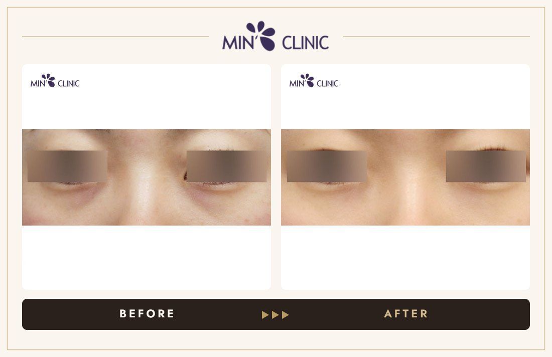 Dual Dark injection before and after, case 14 – MIN Clinic Seoul