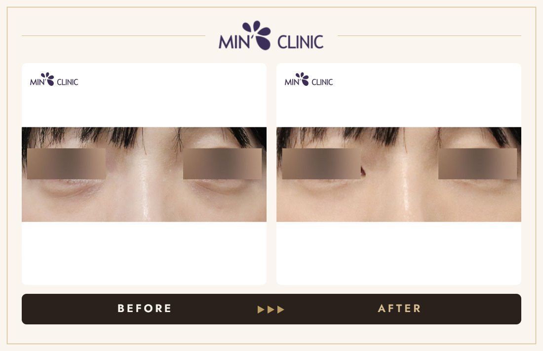 Dual Dark injection before and after, case 15 – MIN Clinic Seoul