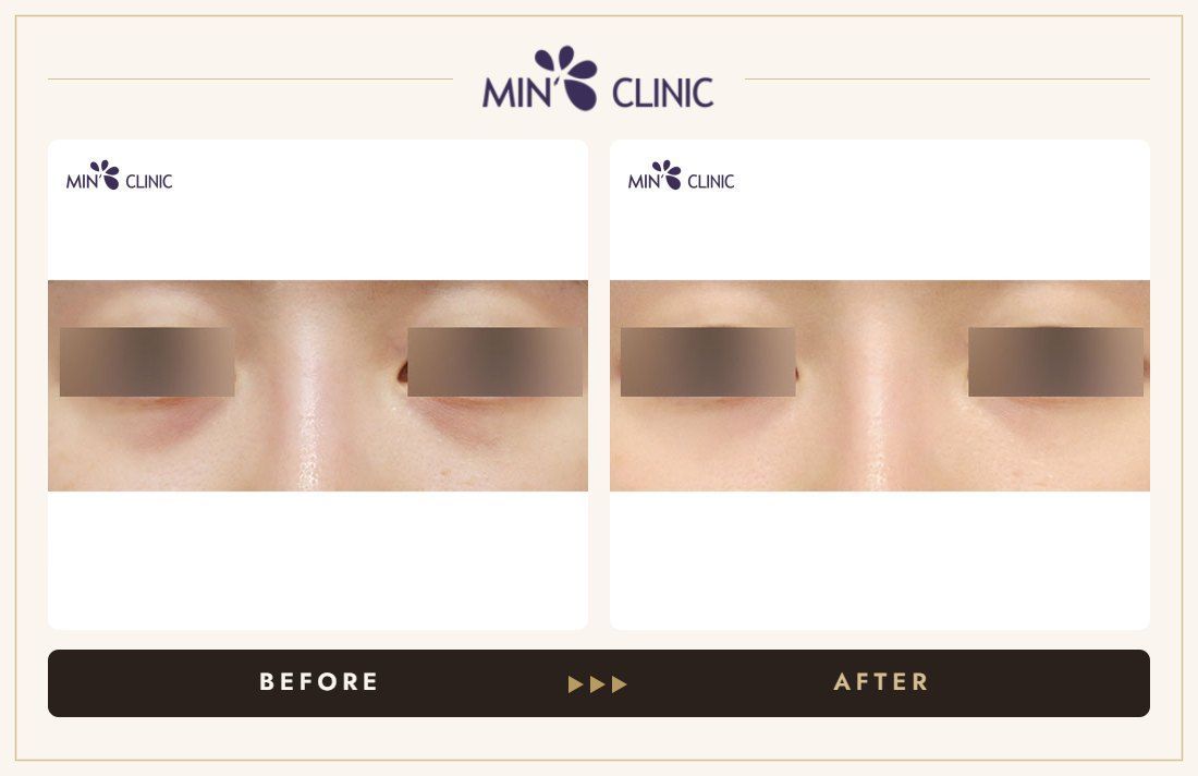 Dual Dark injection before and after, case 16 – MIN Clinic Seoul