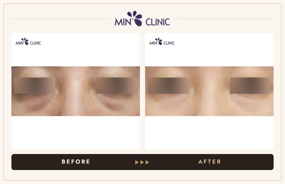 Dual Dark injection before and after, case 17 – MIN Clinic Seoul