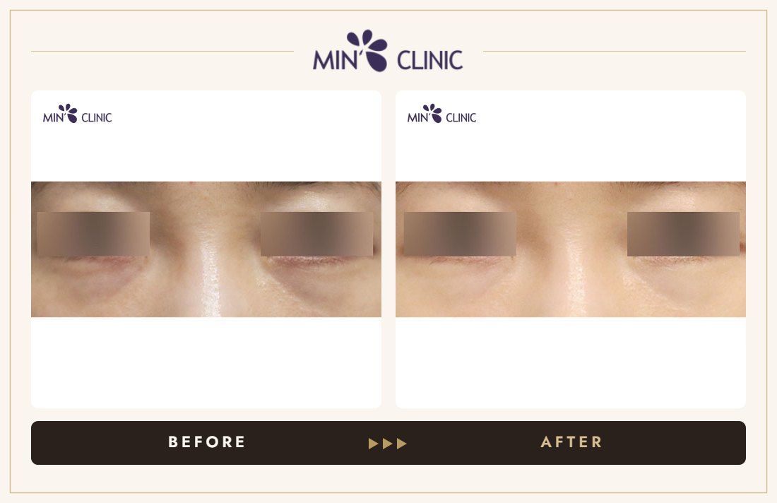 Dual Dark injection before and after, case 18 – MIN Clinic Seoul