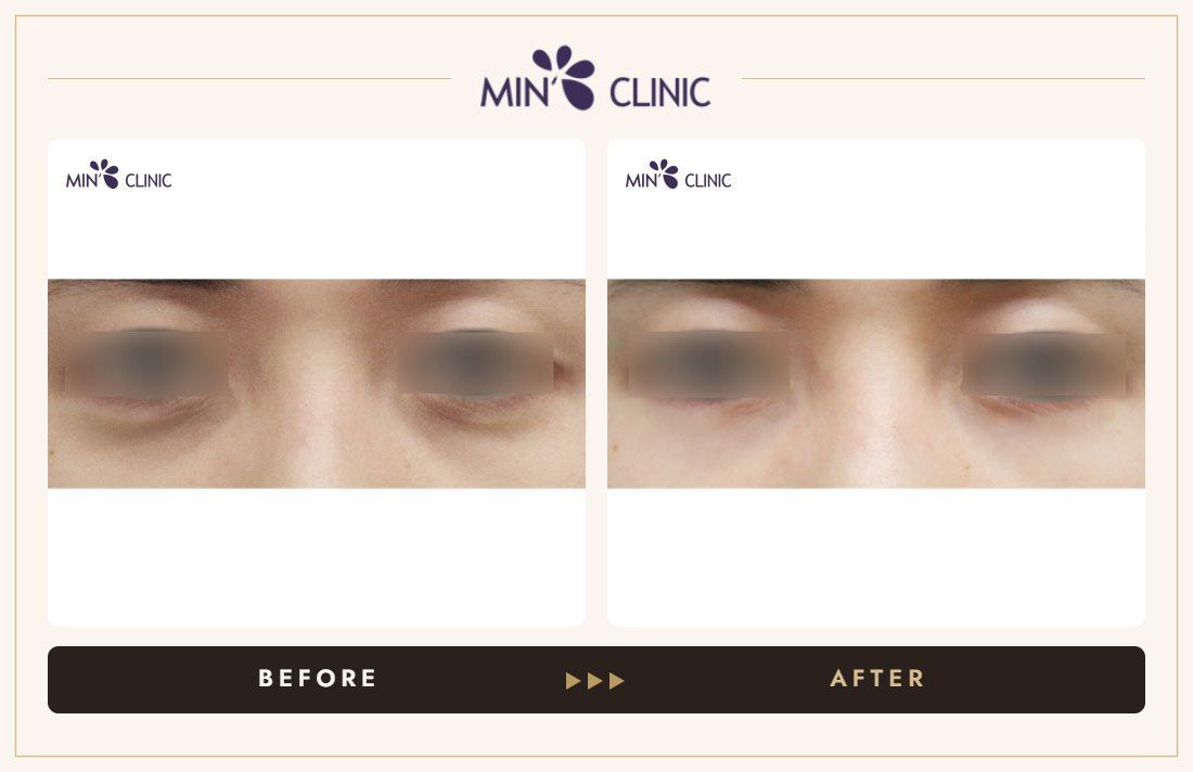 Dual Dark injection before and after, case 19 – MIN Clinic Seoul