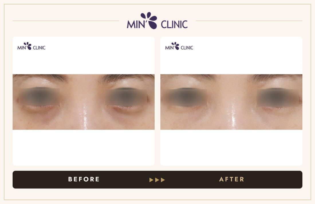 Dual Dark injection before and after, case 20 – MIN Clinic Seoul