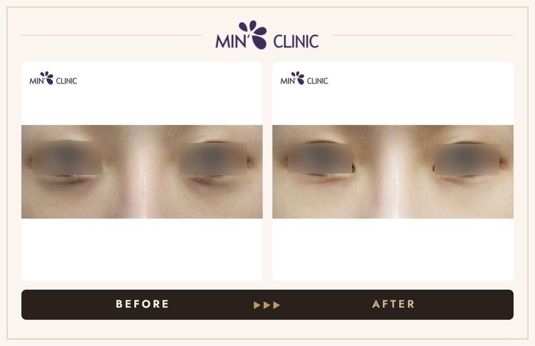 Dual Dark injection before and after, case 21 – MIN Clinic Seoul