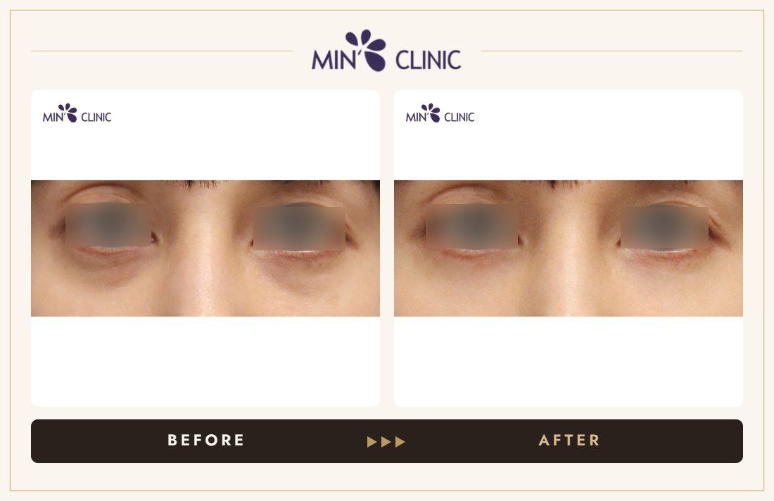 Dual Dark injection before and after, case 22 – MIN Clinic Seoul