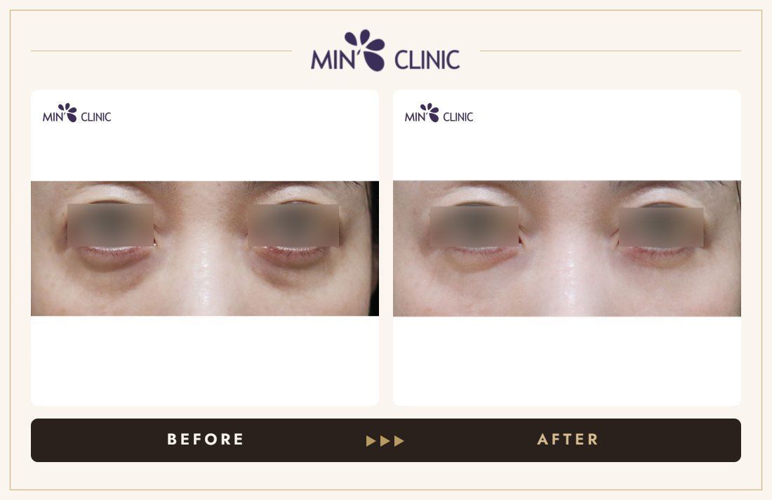 Dual Dark injection before and after, case 23 – MIN Clinic Seoul