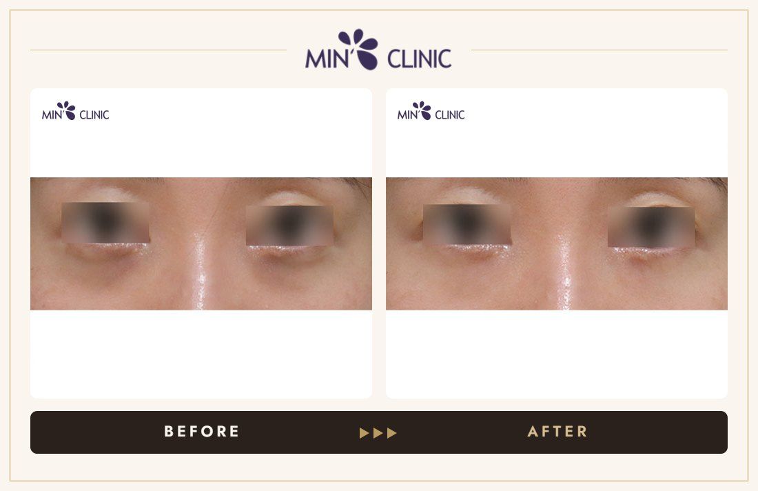 Dual Dark injection before and after, case 24 – MIN Clinic Seoul