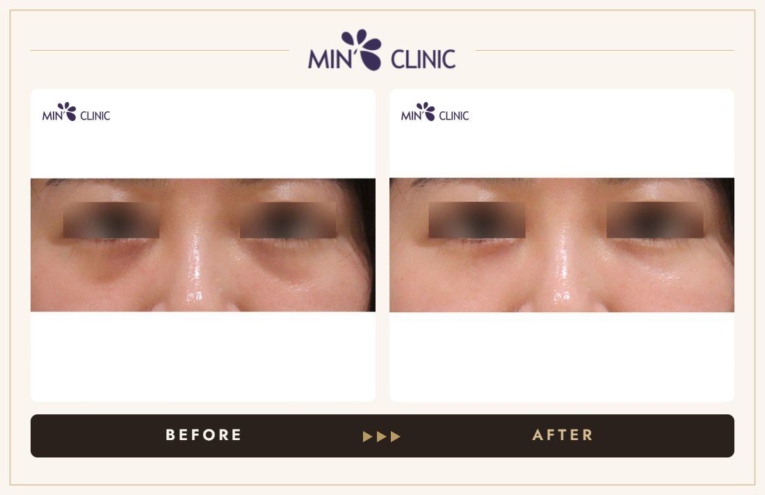 Dual Dark injection before and after, case 25 – MIN Clinic Seoul
