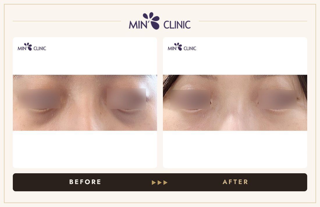 Dual Dark injection before and after, case 26 – MIN Clinic Seoul