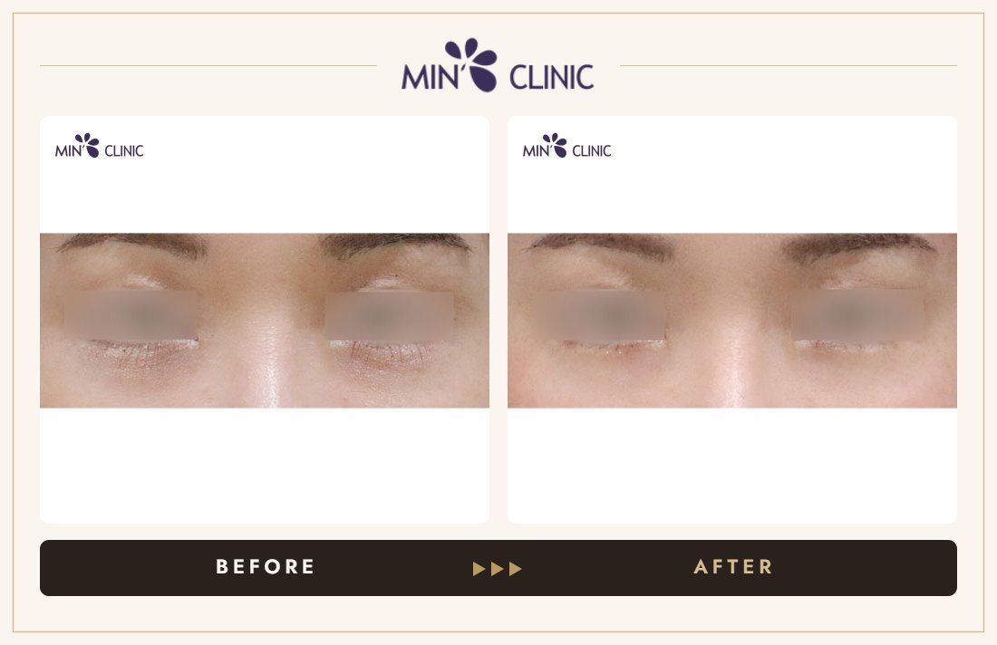 Dual Dark injection before and after, case 27 – MIN Clinic Seoul