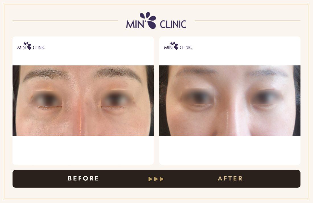 Dual Dark + Rejuran Eye before and after, case 1 – MIN Clinic Seoul
