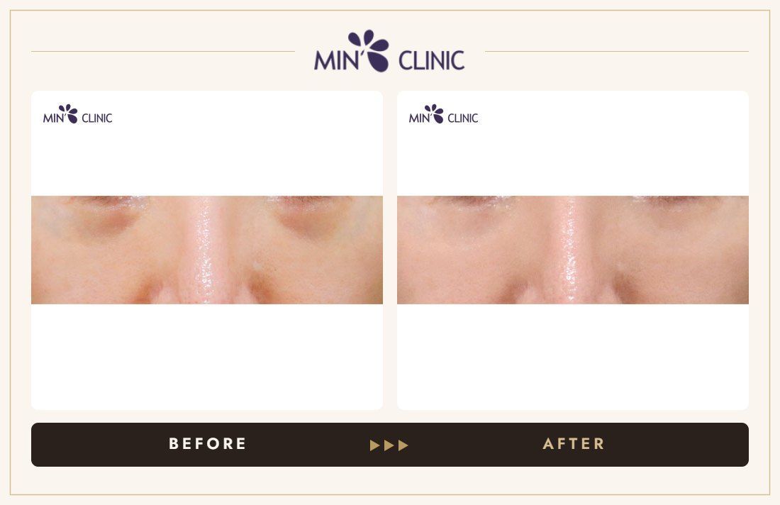 Dual Dark injection before and after, case 31 – MIN Clinic Seoul