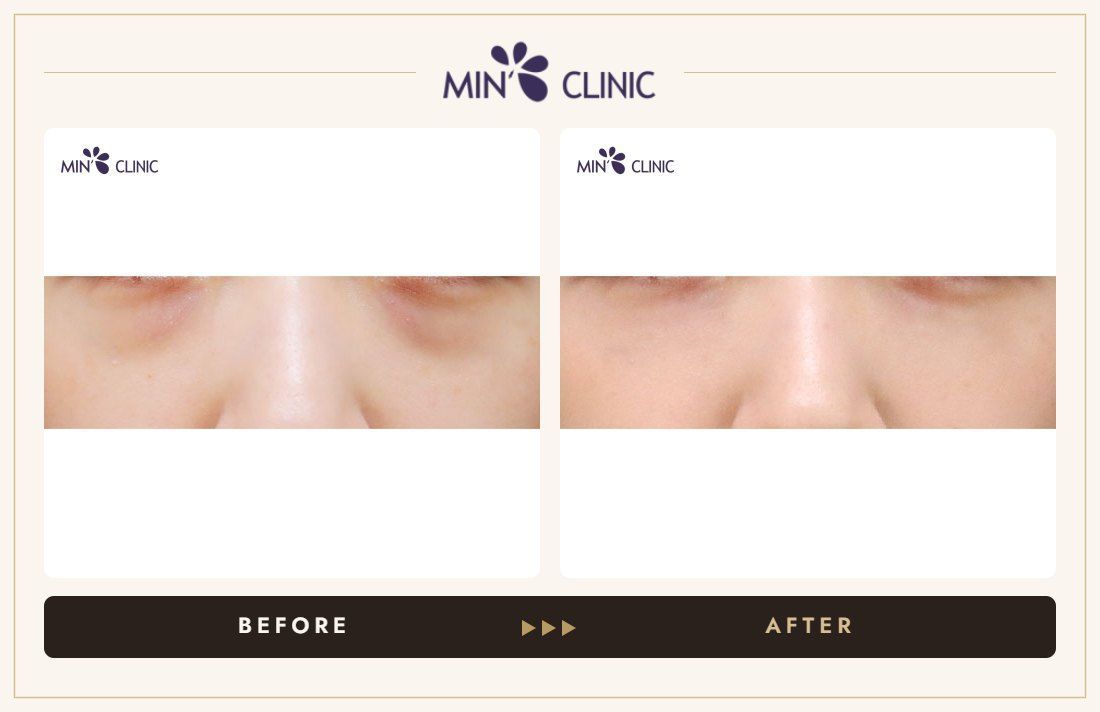 Dual Dark injection before and after, case 32 – MIN Clinic Seoul