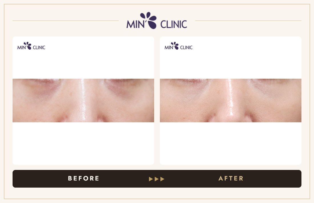 Dual Dark injection before and after, case 33 – MIN Clinic Seoul