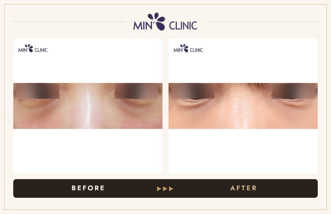 Dark circles & under-eye treatment before and after – MIN Clinic Gangnam, Seoul