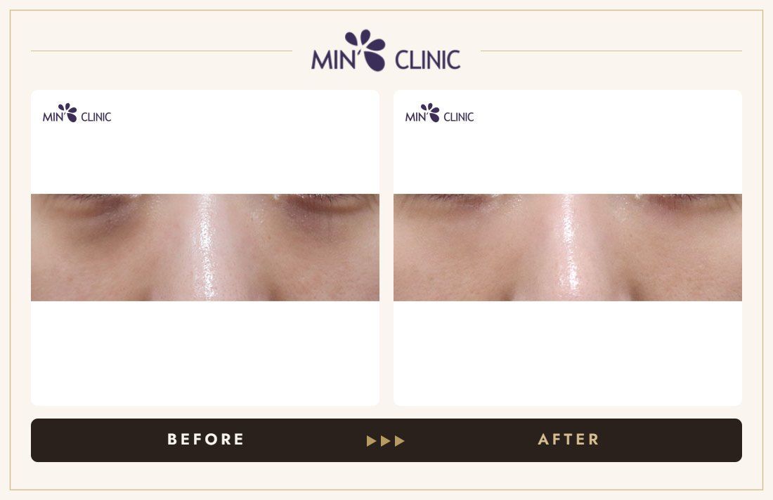 Dual Dark injection before and after, case 30 – MIN Clinic Seoul