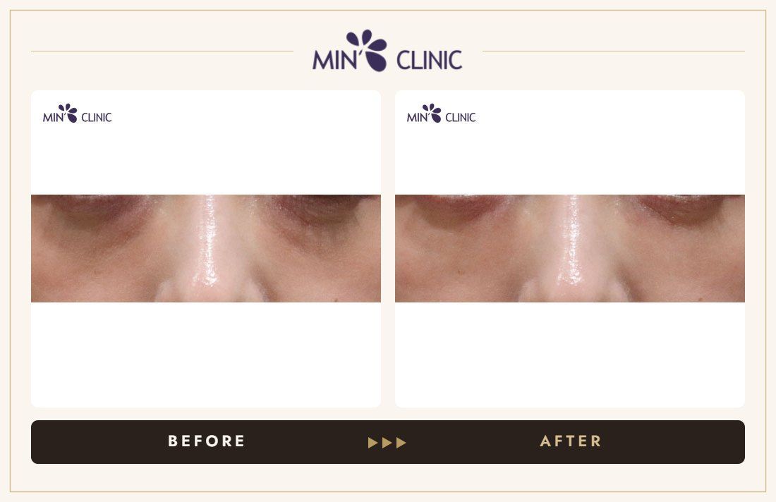 Dual Dark injection before and after, case 29 – MIN Clinic Seoul