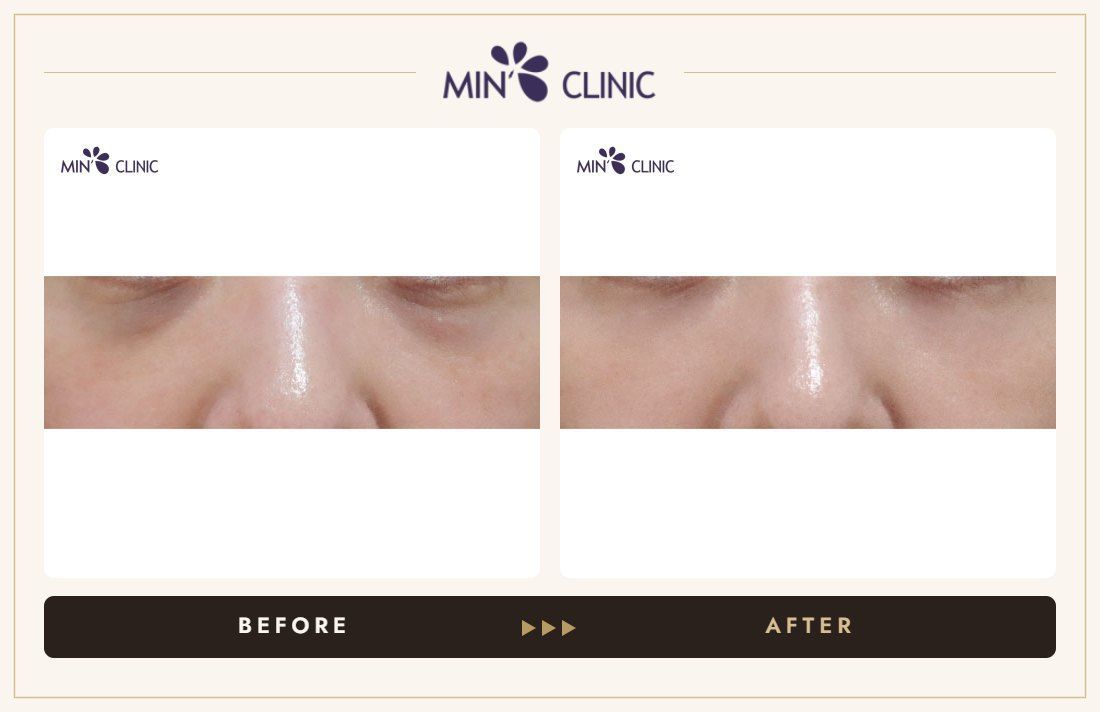 Dual Dark injection before and after, case 28 – MIN Clinic Seoul