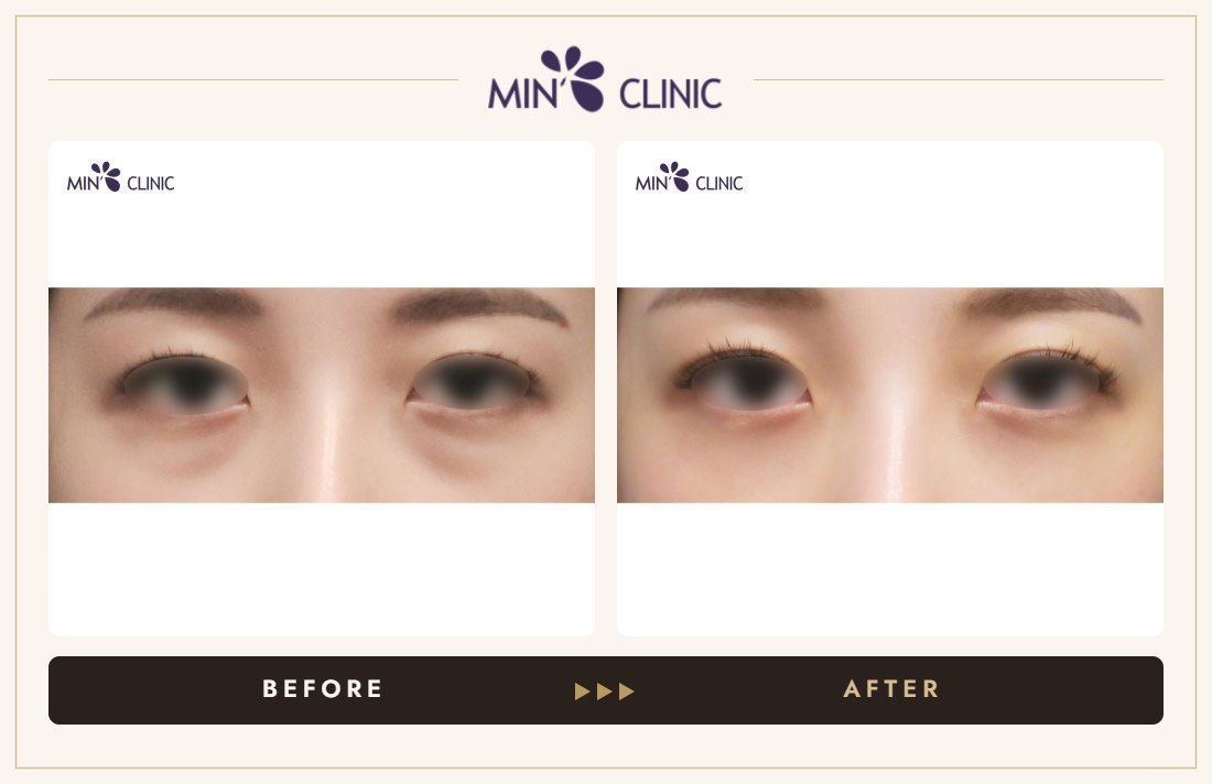 Dual Dark injection before and after, case 2 – MIN Clinic Seoul