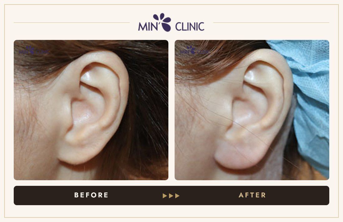 Earlobe filler before and after, case 4 – MIN Clinic Seoul