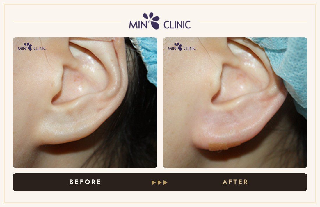 Earlobe filler before and after, case 3 – MIN Clinic Seoul