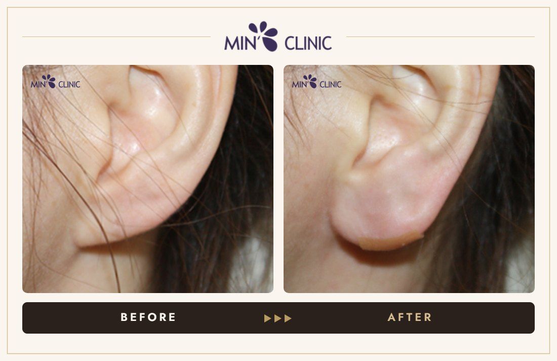 Earlobe filler before and after, case 2 – MIN Clinic Seoul