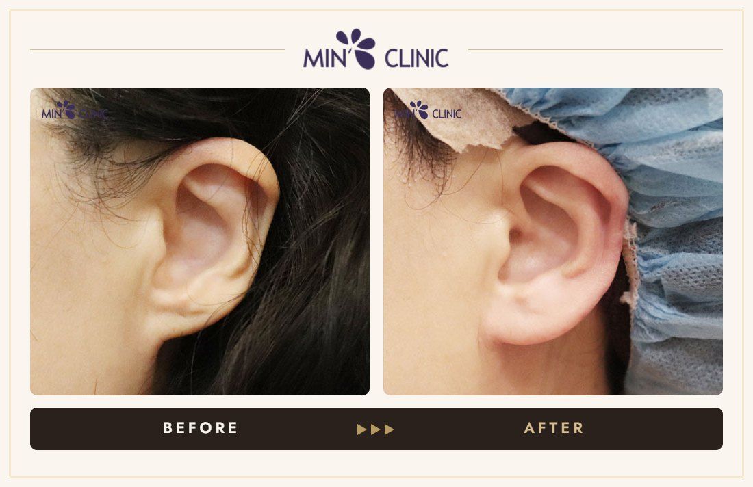 Earlobe filler before and after, case 5 – MIN Clinic Seoul