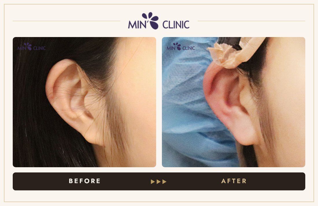 Earlobe filler before and after, case 6 – MIN Clinic Seoul