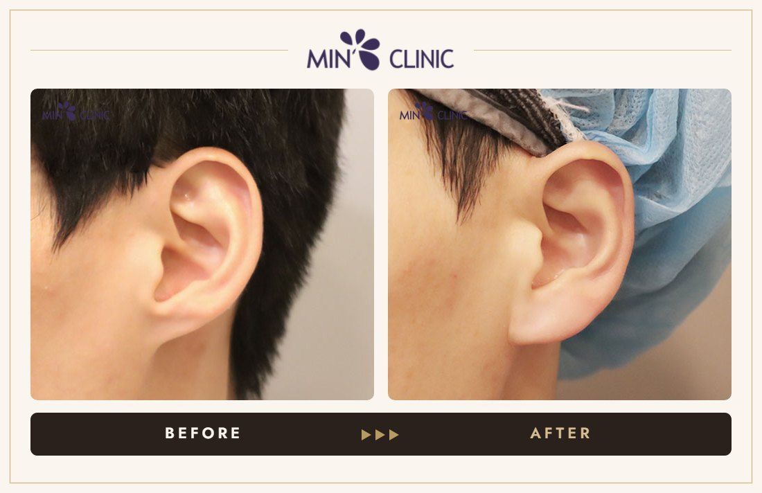 Earlobe filler before and after, case 7 – MIN Clinic Seoul