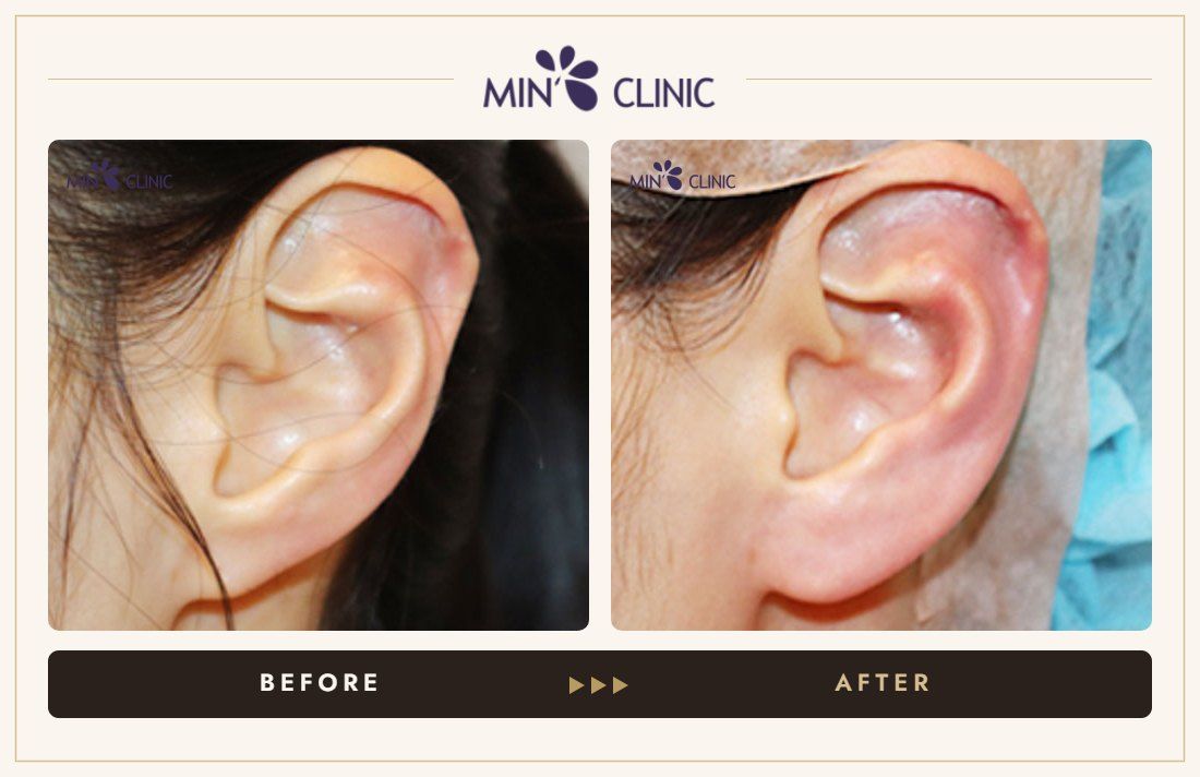 Earlobe filler before and after, case 8 – MIN Clinic Seoul