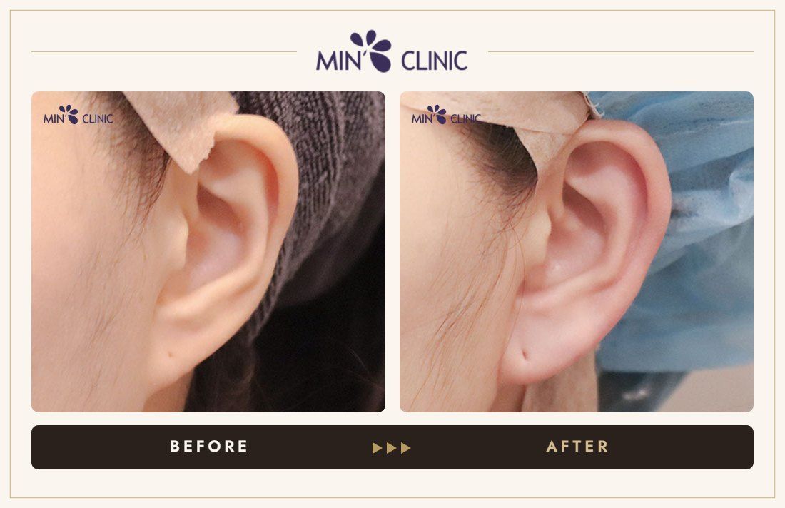 Earlobe filler before and after, case 9 – MIN Clinic Seoul