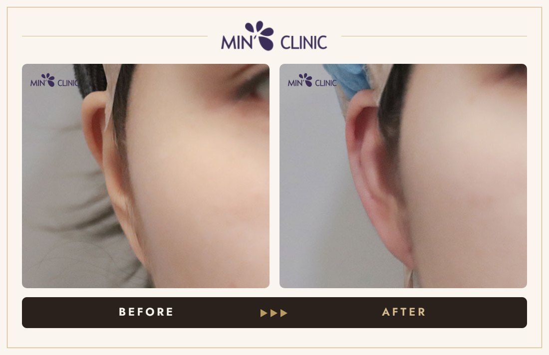 Earlobe filler before and after, case 10 – MIN Clinic Seoul
