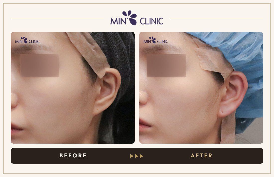 Earlobe filler before and after, case 11 – MIN Clinic Seoul