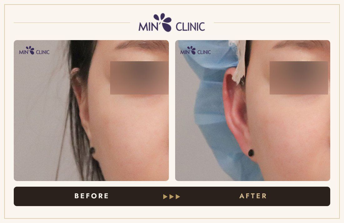 Earlobe filler before and after, case 12 – MIN Clinic Seoul
