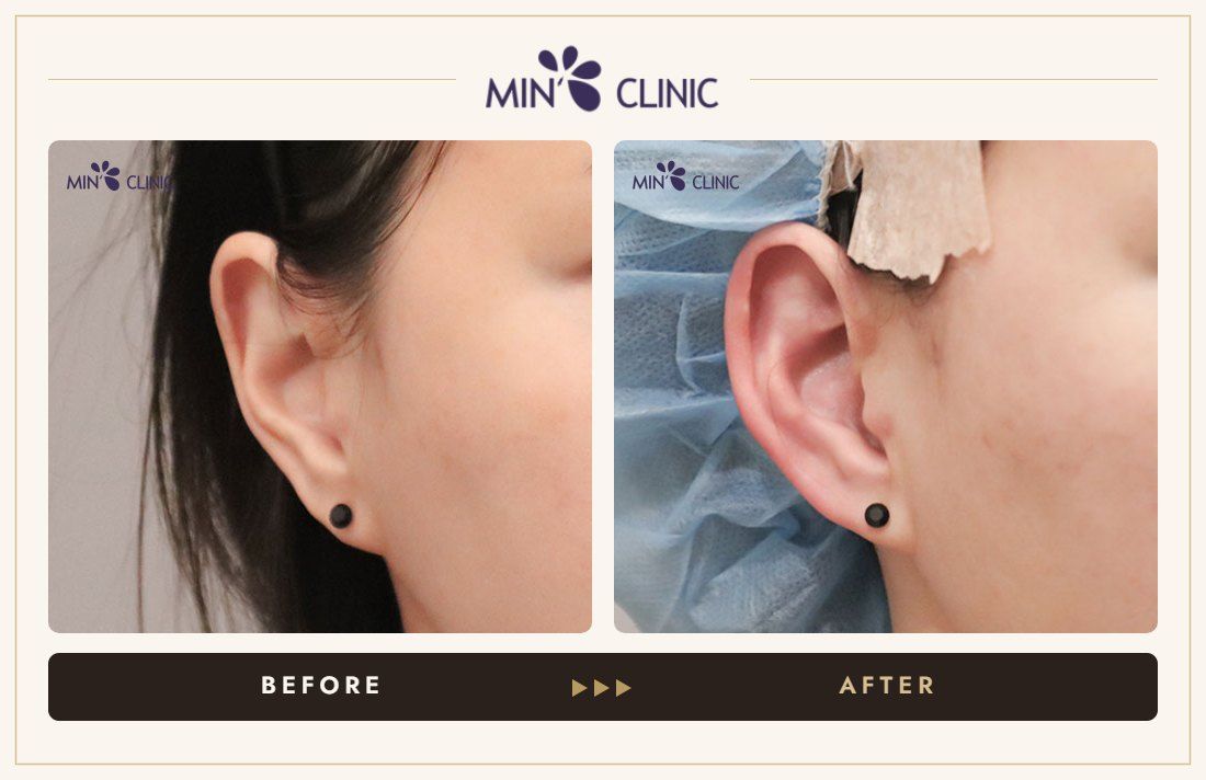 Earlobe filler before and after, case 13 – MIN Clinic Seoul