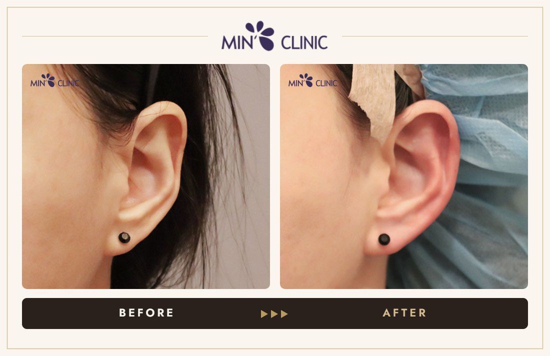 Earlobe filler before and after, case 14 – MIN Clinic Seoul
