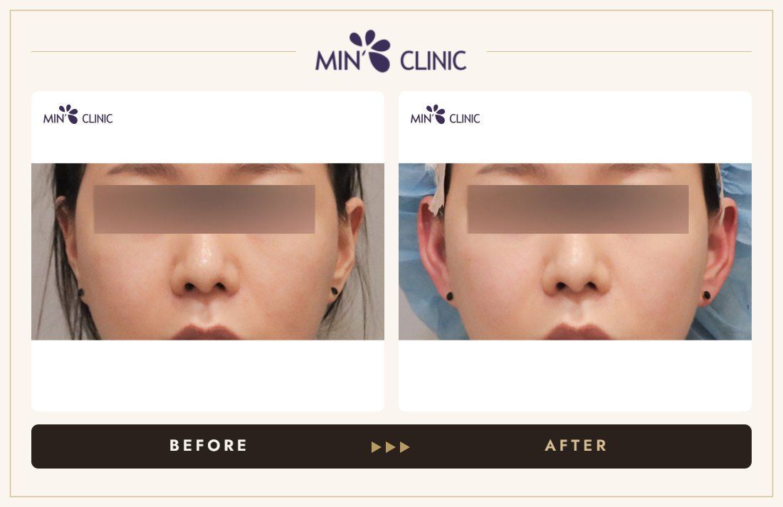 Earlobe filler before and after, case 15 – MIN Clinic Seoul