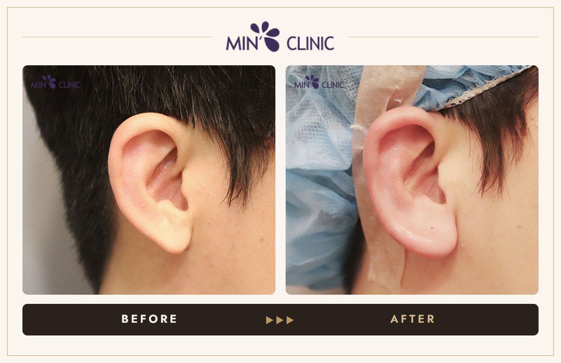 Earlobe filler before and after, case 16 – MIN Clinic Seoul