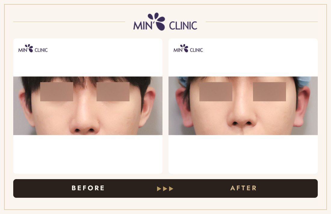 Earlobe filler before and after, case 17 – MIN Clinic Seoul