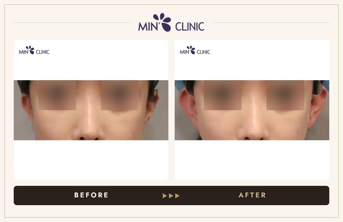 Earlobe filler before and after, case 18 – MIN Clinic Seoul