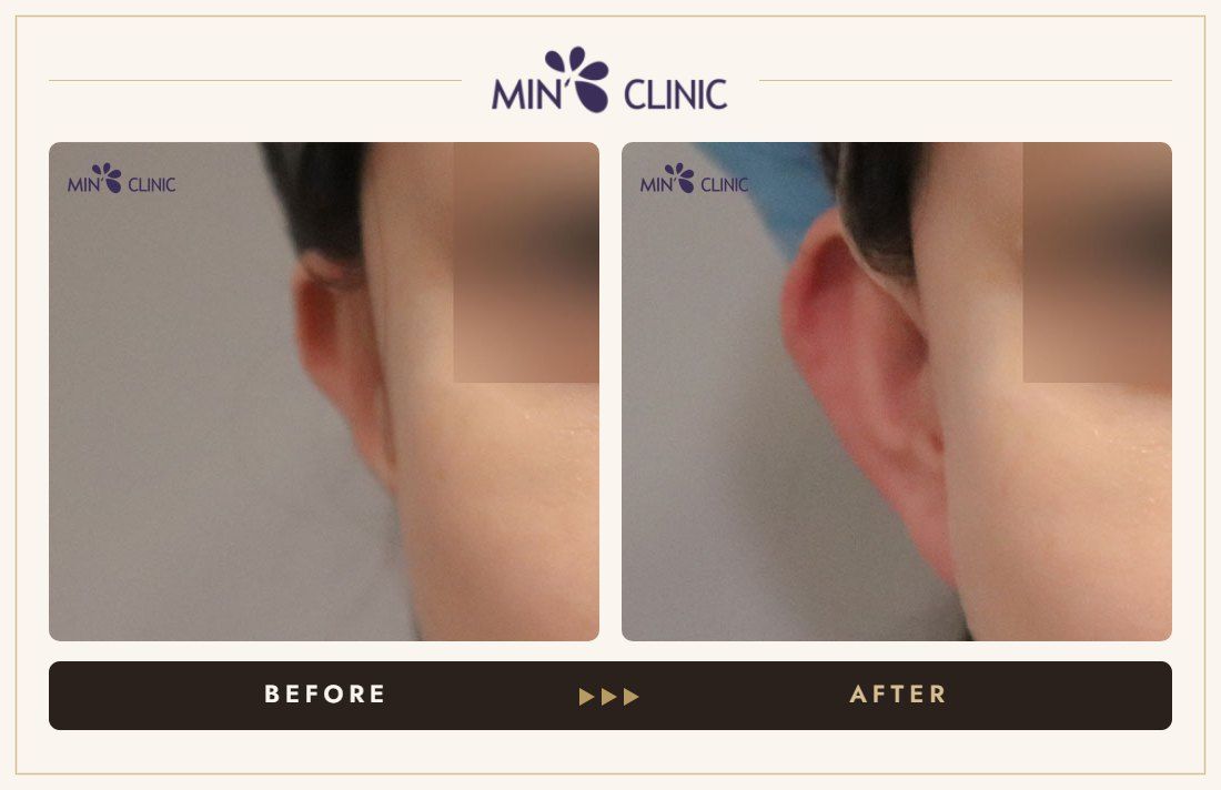 Earlobe filler before and after, case 19 – MIN Clinic Seoul