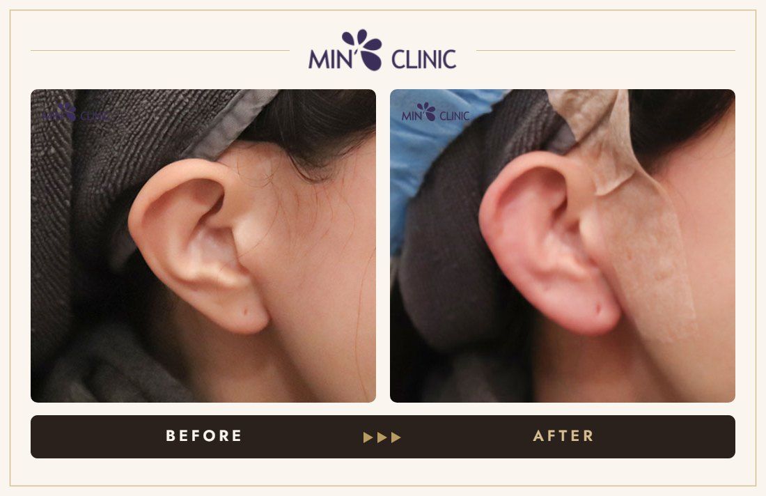 Earlobe filler before and after, case 20 – MIN Clinic Seoul