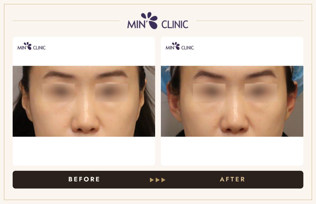 Earlobe filler before and after, case 21 – MIN Clinic Seoul