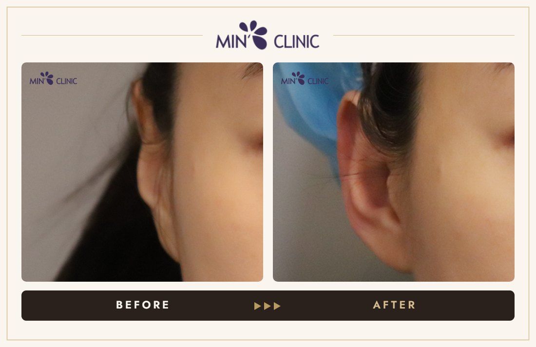 Earlobe filler before and after, case 22 – MIN Clinic Seoul