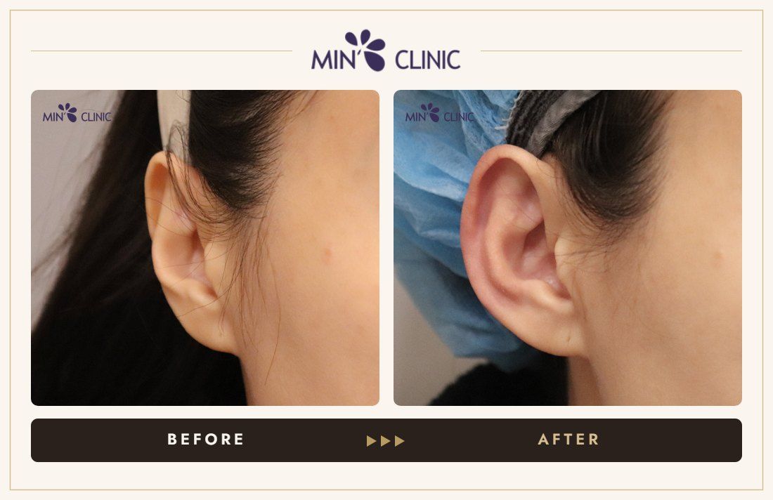 Earlobe filler before and after, case 23 – MIN Clinic Seoul