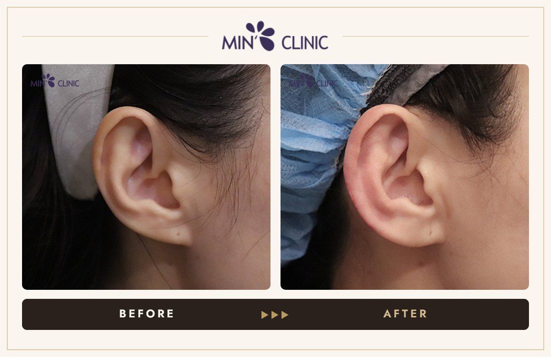 Earlobe filler before and after, case 24 – MIN Clinic Seoul