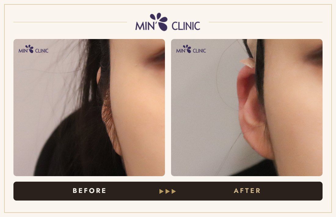 Earlobe filler before and after, case 25 – MIN Clinic Seoul