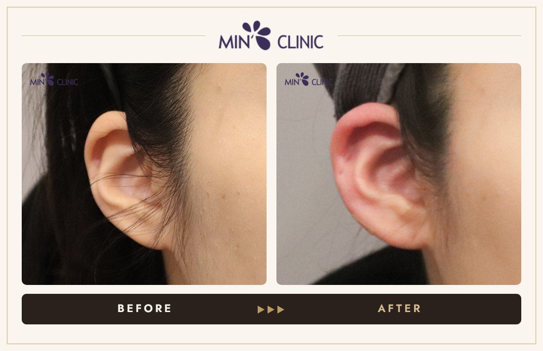 Earlobe filler before and after, case 26 – MIN Clinic Seoul