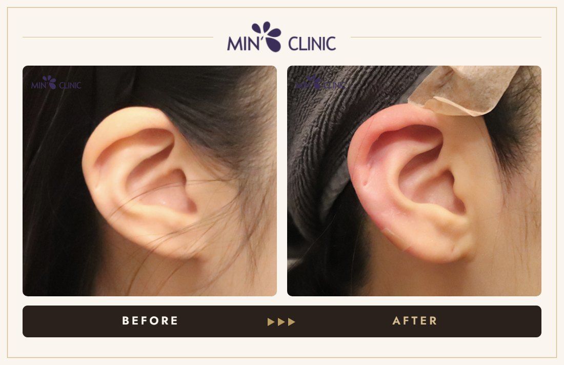 Earlobe filler before and after, case 27 – MIN Clinic Seoul