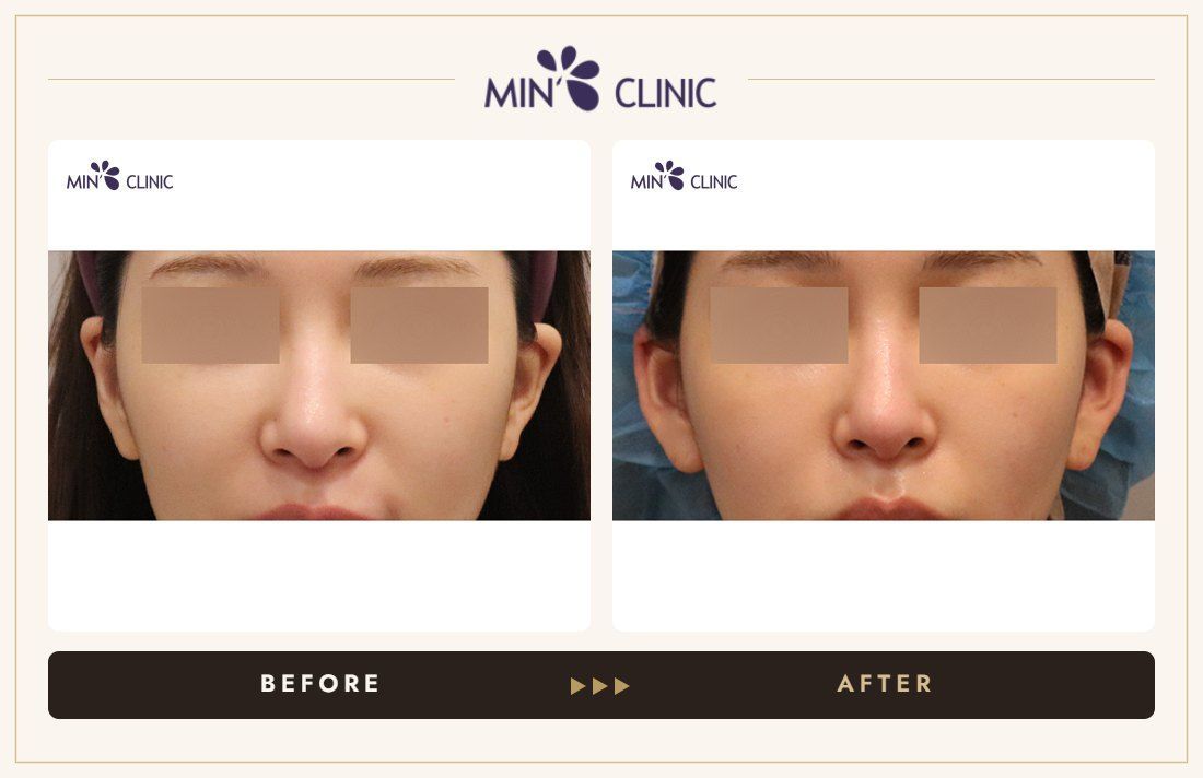 Earlobe filler before and after – MIN Clinic Gangnam, Seoul